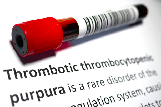GorodoCher.ru | Геморрагический синдром при идиопатической тромбоцитопенической пурпуре: чем характеризуется?